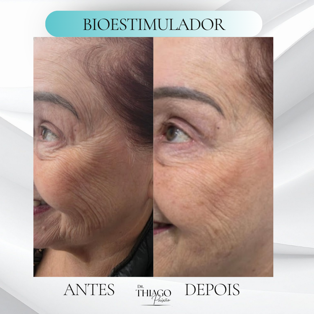 Antes e depois Bioestimuladores