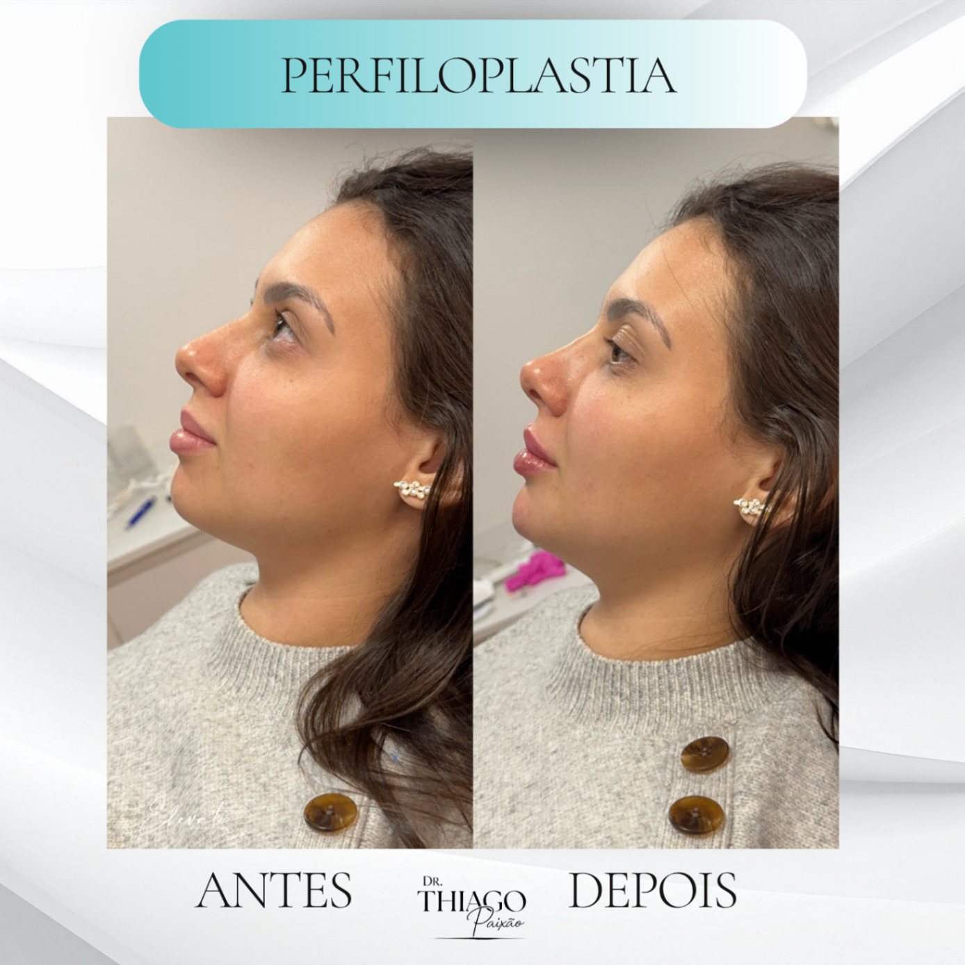 Antes e depois de Perfiloplastia, Dr. Thiago Paixão