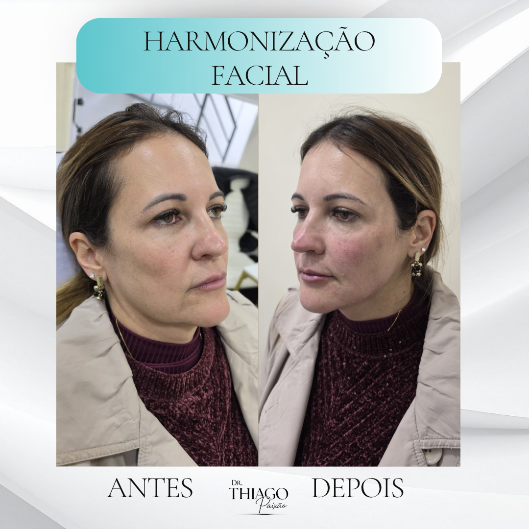 Antes e depois Harmonização