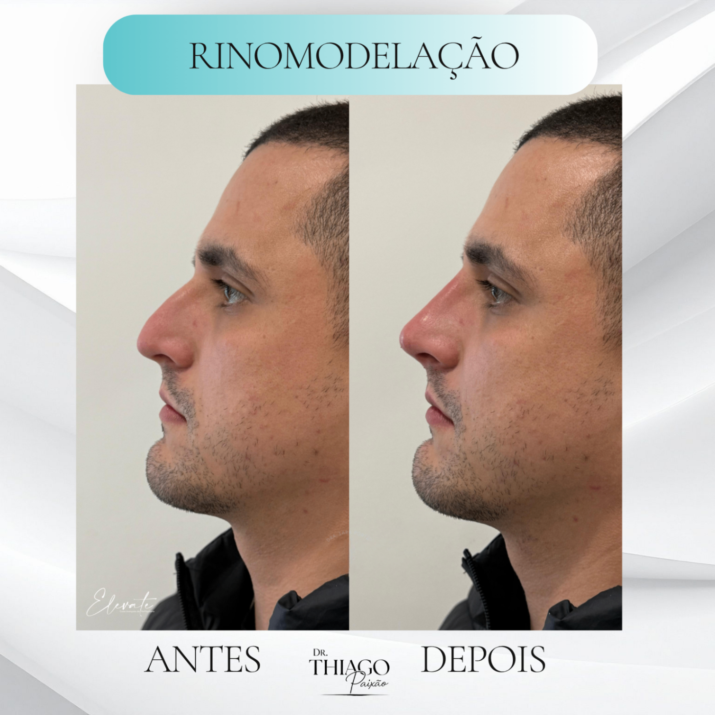 Antes e depois de Rinomodelação, Dr. Thiago Paixão