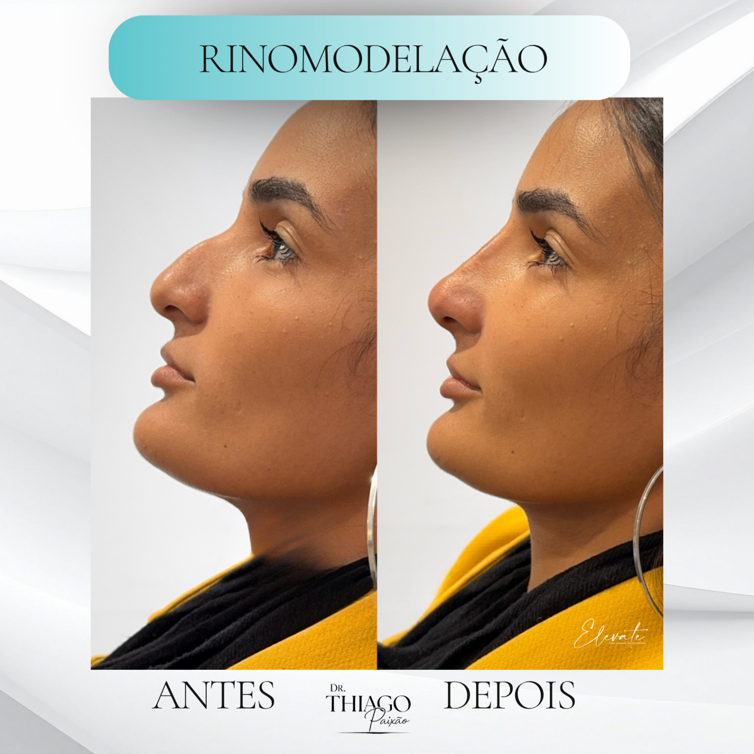 Antes e depois de Rinomodelação, Dr. Thiago Paixão