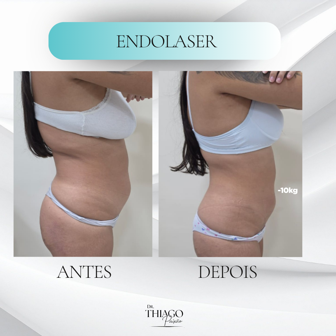 Antes e depois Corporal
