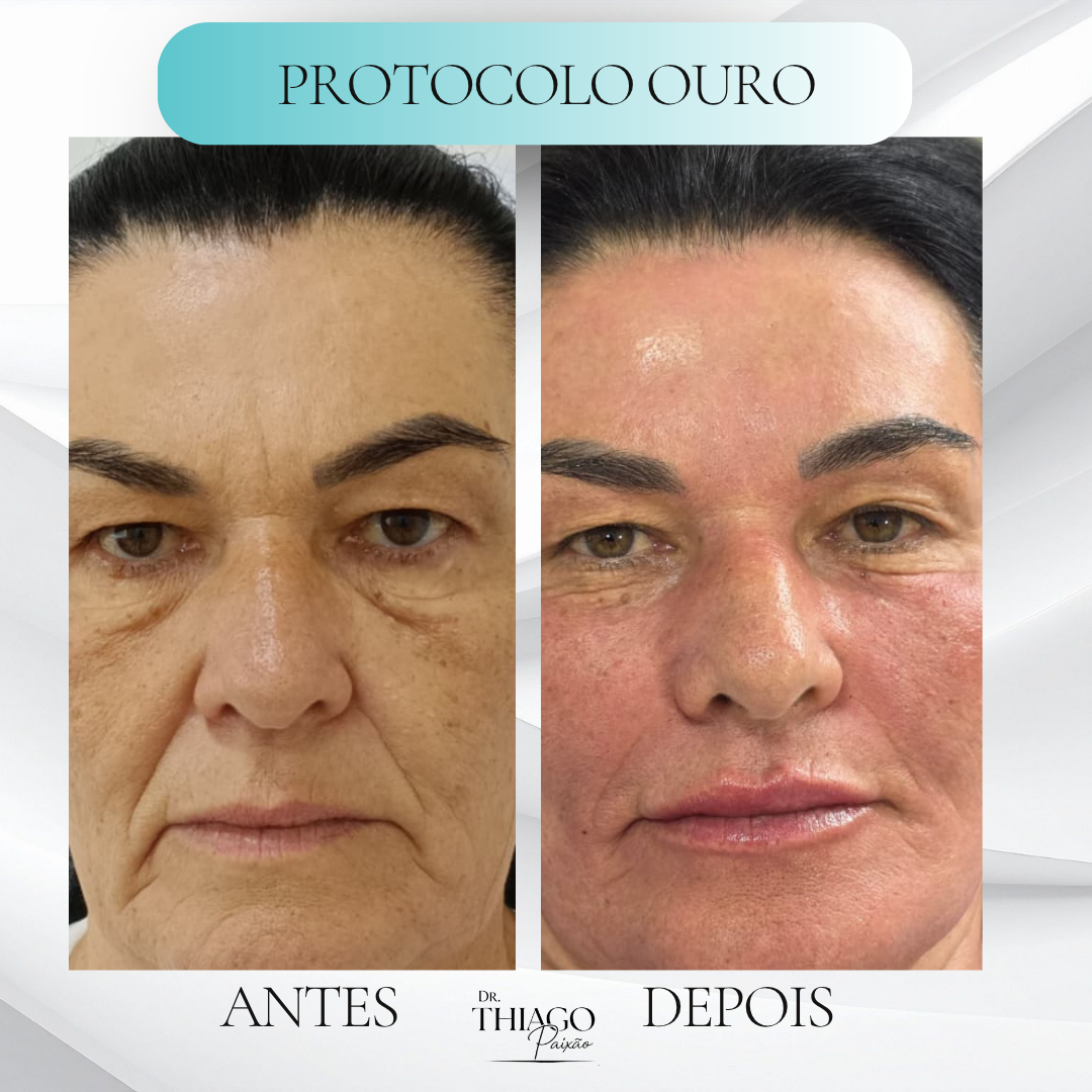 Antes e depois Protocolos