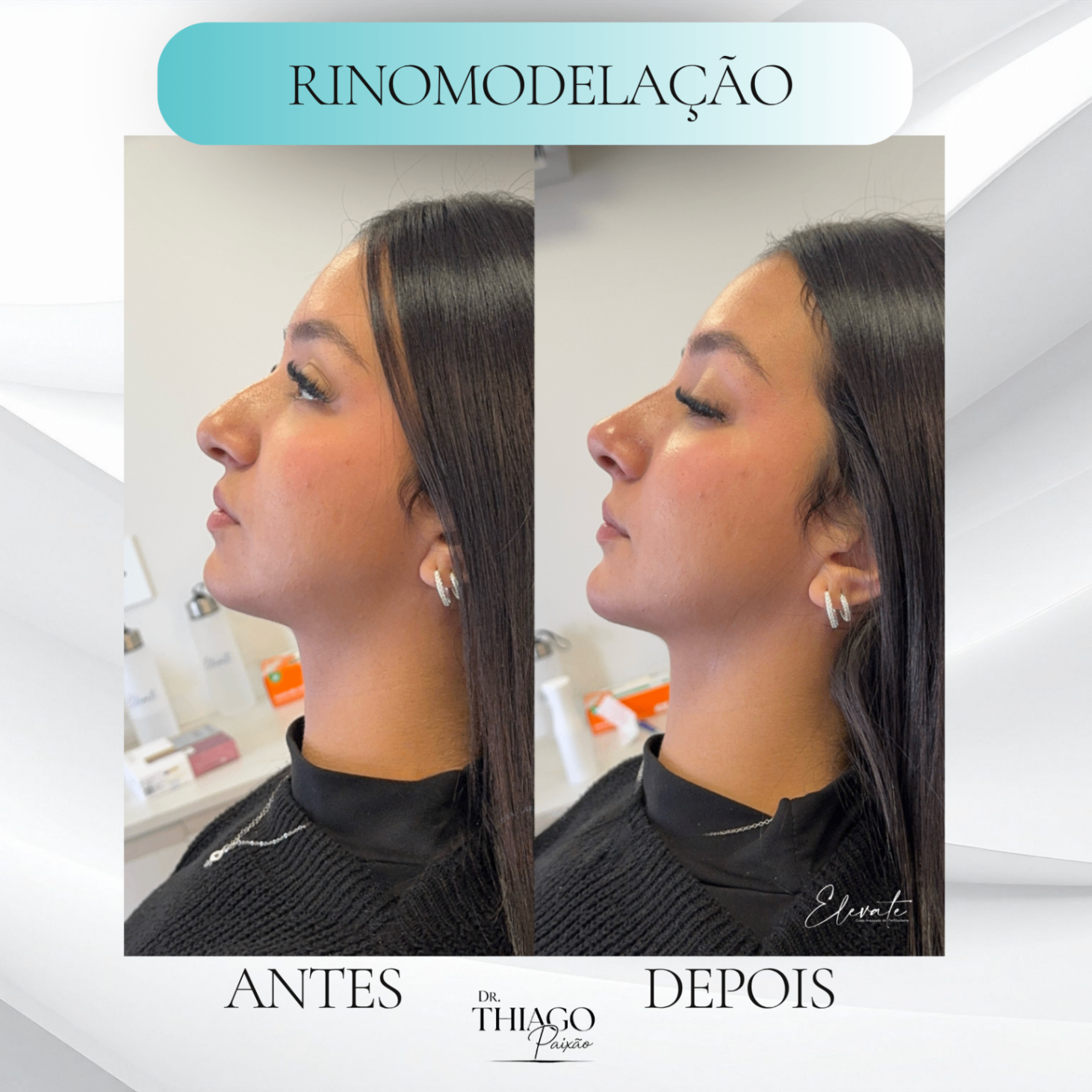 Antes e depois de Rinomodelação, Dr. Thiago Paixão