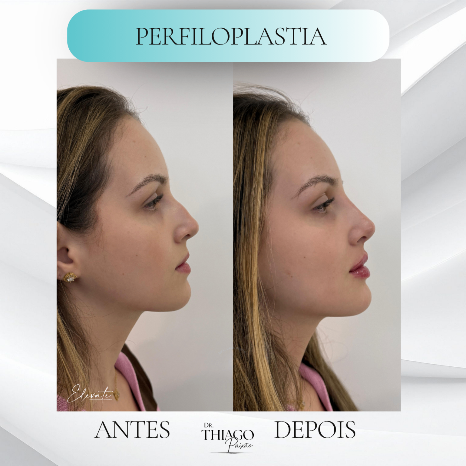 Antes e depois de Perfiloplastia, Dr. Thiago Paixão