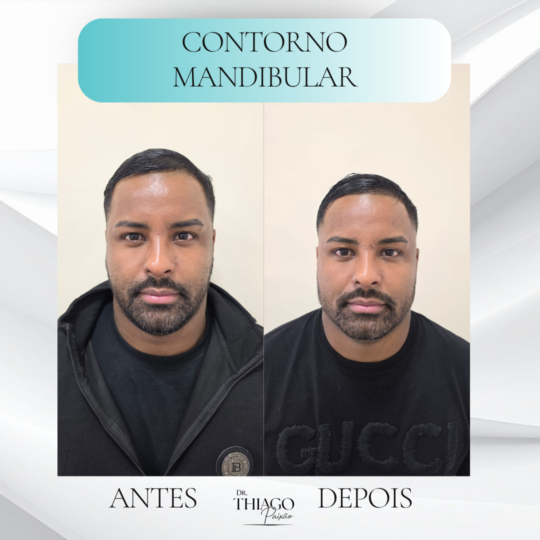Antes e depois de Contorno mandibular, Dr. Thiago Paixão