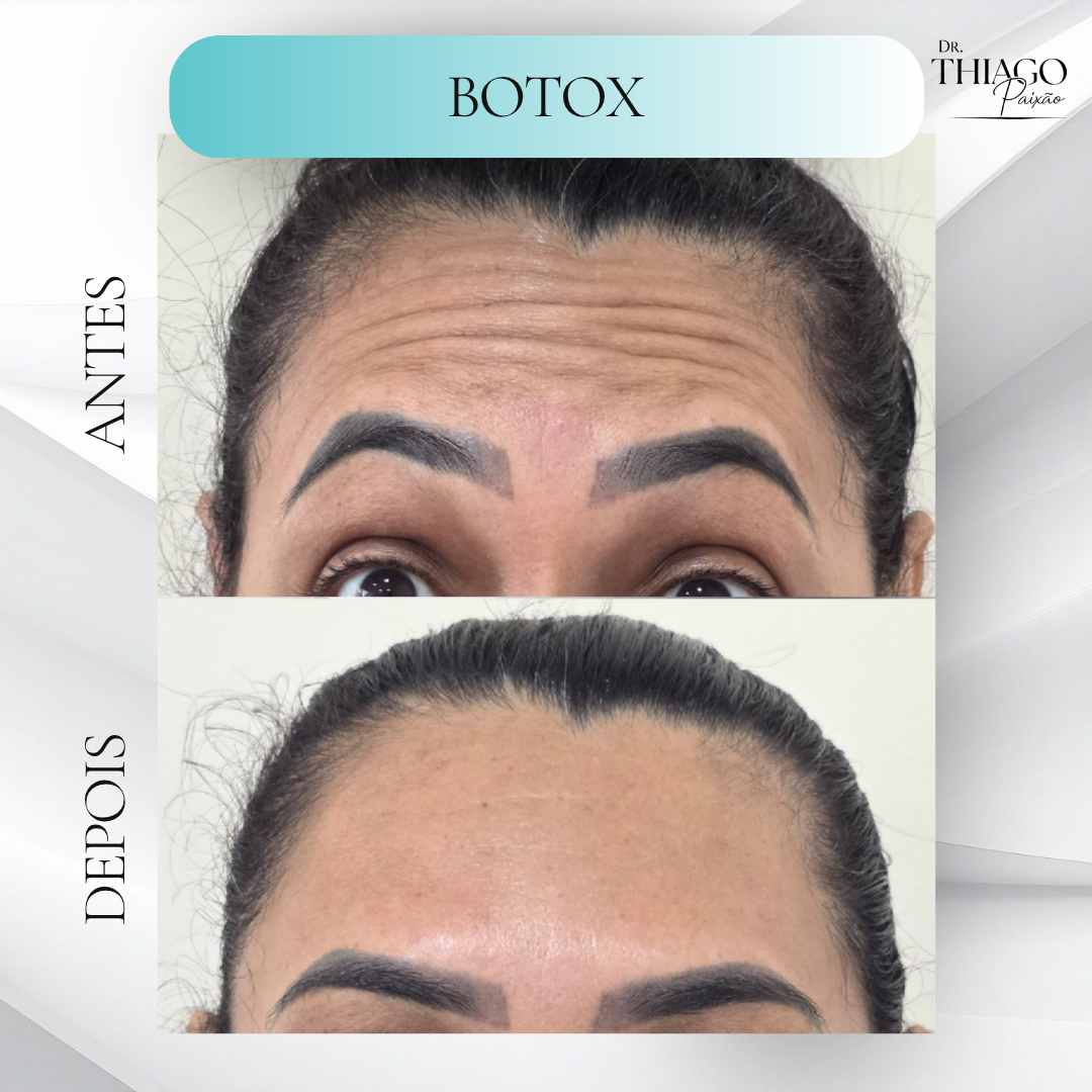 Antes e depois Botox