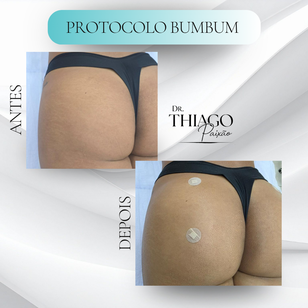 Antes e depois Celulite & Estrias